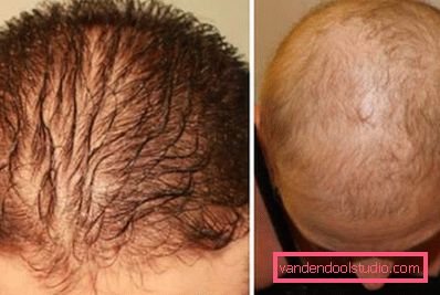 alopecia stage alopecia stage