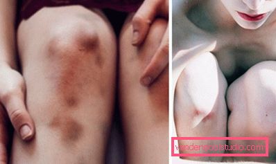 bruised legs bruised legs