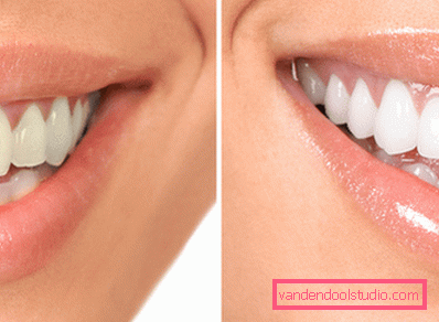 teeth before and after a session with air flow teeth before and after a session with air flow