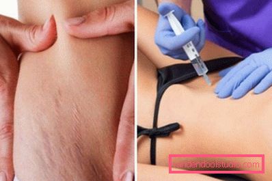 stretch marks injections