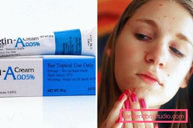 Cream tretinoin