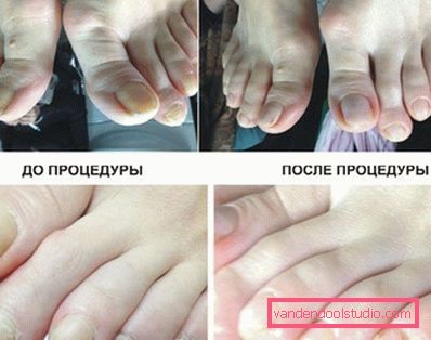 before and after the procedure before and after the procedure