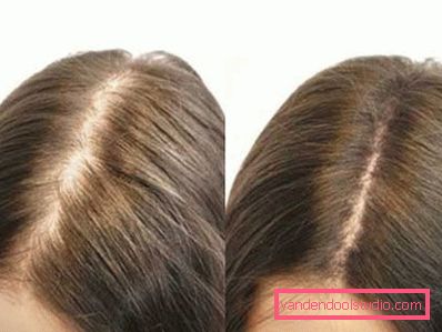 Hair mesotherapy