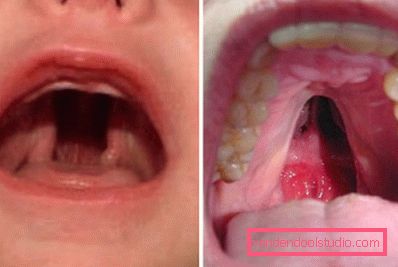 cleft palate