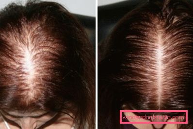 before and after the procedure before and after the procedure