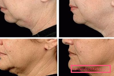 before and after the procedure before and after the procedure