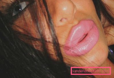 huge silicone lips