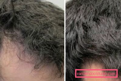 bald spots bald spots