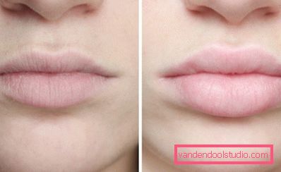 before and after lip augmentation with hyaluronic acid before and after lip augmentation with hyaluronic acid